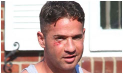 Mike The Situation with blood under his eye